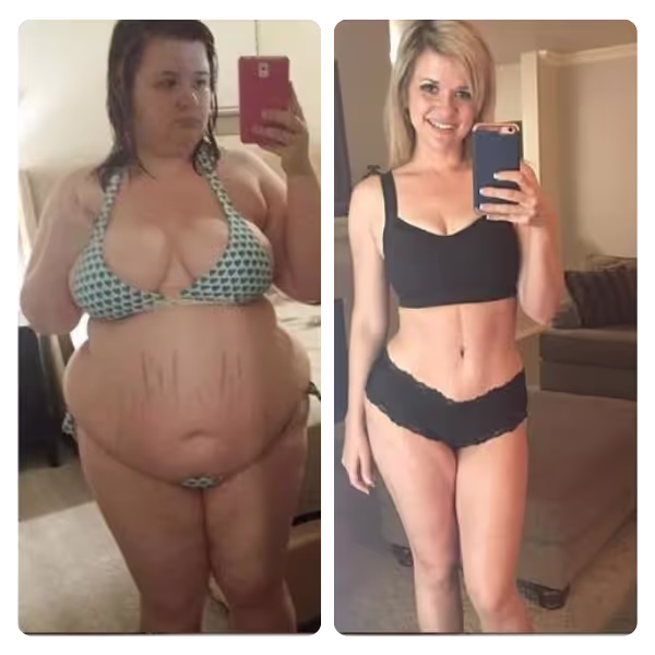 Tummy Tuck in Turkey